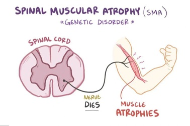 Sàng lọc sớm giúp phát hiện các bệnh teo cơ di truyền nguy hiểm