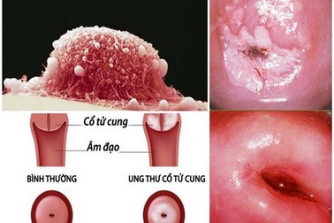 Lây nhiễm HPV và nguy cơ ung thư cổ tử cung