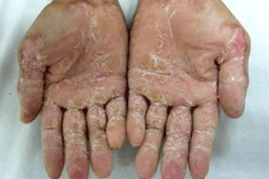 Sợ lây “bệnh lạ”, người dân hoang mang, học sinh nghỉ học 