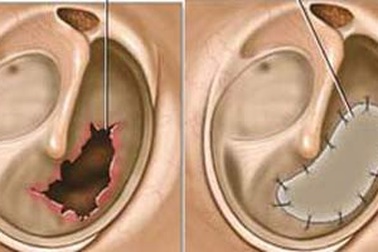 Vá màng nhĩ chữa viêm tai tái diễn?