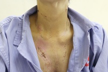 Người phụ nữ bị sét đánh tóc dựng ngược, thủng màng nhĩ, bỏng điện