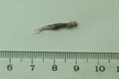 Kí sinh trùng lạ trong phổi bệnh nhi thuộc dòng nhuyễn thể