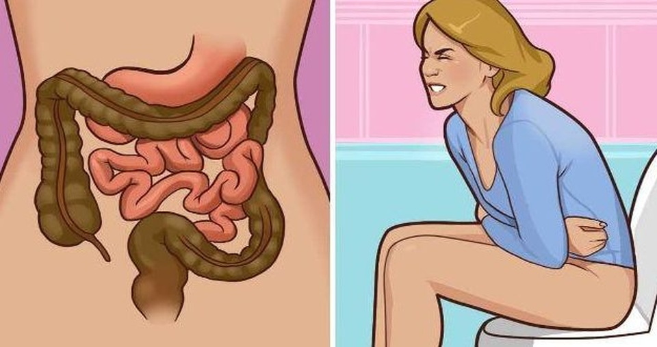 7 dấu hiệu cảnh báo sớm ung thư đại trực tràng - 2 7 dấu hiệu cảnh báo sớm ung thư đại trực tràng - 2
