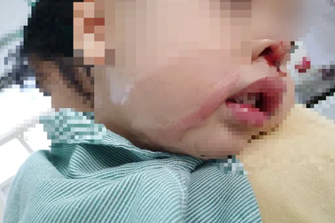 Mẹ ngất xỉu vì nhầm lọ axit tẩy nốt ruồi là nước muối, nhỏ vào mũi con 4 tháng tuổi