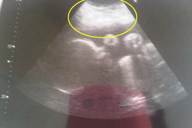 29 năm mang thai người anh em song sinh của mình trong tử cung