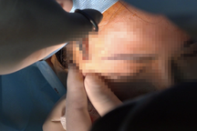 Vụ nguy kịch sau khi tiêm filler mặt, ngực: Cơ sở thẩm mỹ chỉ "tiêm hộ"?