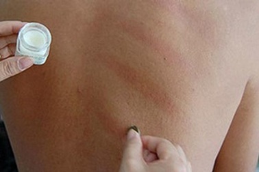 Cạo gió thế nào cho đúng?