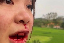 Cô gái 23 tuổi tố cáo bị tài xế ô tô hành hung