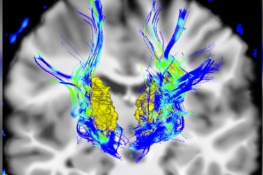 Cảnh giác với bệnh Parkinson nếu mắt có những triệu chứng này