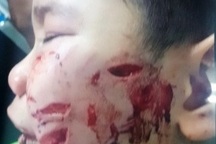 Bị chó cắn nát mặt, bé trai phải khâu 200 mũi