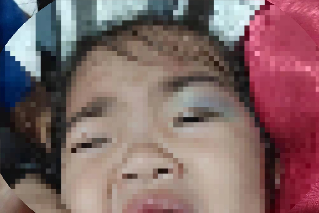 3 سالہ بچی کے سکول کے بعد جسم پر زخموں اور دانتوں کے بہت سے نشانات ہیں - 2 Bé gái 3 tuổi bị nhiều vết bầm tím, dấu răng trên người sau giờ học - 2