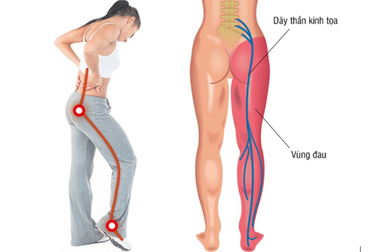 Đau thần kinh tọa ngày càng trẻ hóa: Hậu quả nghiêm trọng khi điều trị muộn