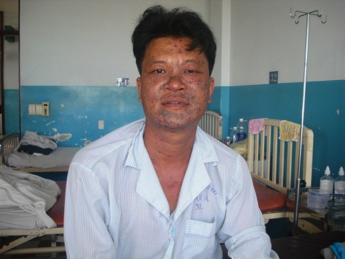 Bệnh thủy đậu hoành hành