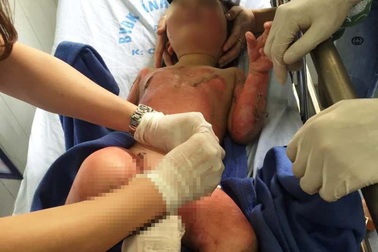 3 em nhỏ bỏng cồn trong giờ học dạy chống cháy nổ phải ghép da