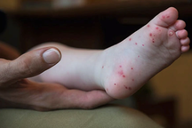 Phát hiện mới nhất về loại virus gây bệnh tay chân miệng nặng ở TPHCM