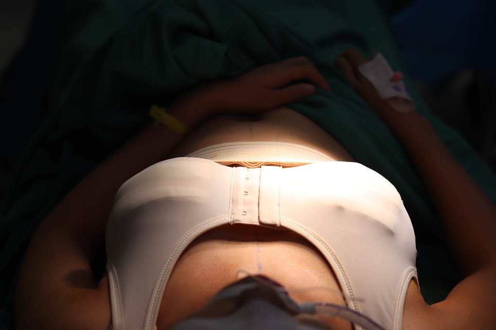 Nâng ngực và các yếu tố hình thành sẹo - 1 Nâng ngực và các yếu tố hình thành sẹo - 1