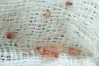 Nhiều mảnh kính vỡ nằm sâu trong mũi người đàn ông