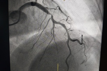 Cẩn trọng cơn đau ngực cấp tính báo động bệnh mạch vành nguy hiểm