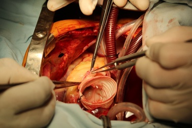 Cứu sống bé trai 12 tuổi bị vỡ phình bóc tách động mạch chủ