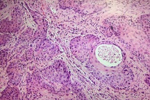 Loại ung thư liên quan đến bệnh tình dục đáng sợ gấp bội