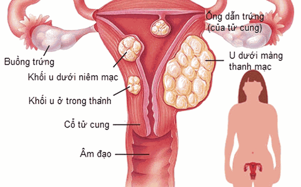 U xơ tử cung và những nguy cơ khó lường chị em cần biết - 2 U xơ tử cung và những nguy cơ khó lường chị em cần biết - 2