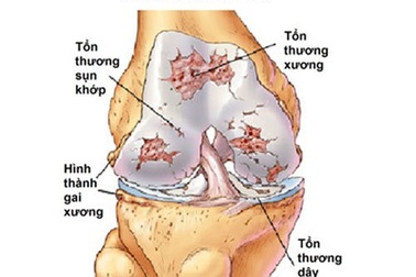 Thoái hóa khớp - Căn nguyên làm giảm chất lượng cuộc sống