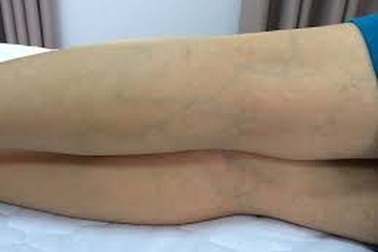 Suy tĩnh mạch: Phòng hơn chữa