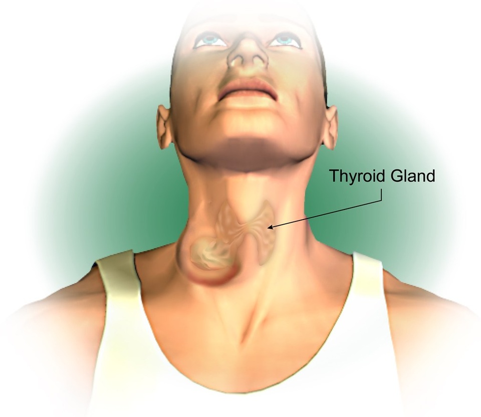 Xét nghiệm nào chẩn đoán ung thư tuyến giáp - 1 Xét nghiệm nào chẩn đoán ung thư tuyến giáp - 1