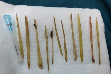 Ngủ ngậm tăm xỉa răng, 11 que tăm "chui" vào ổ bụng