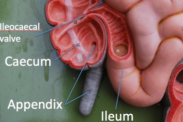 Triệu chứng ung thư ruột thừa
