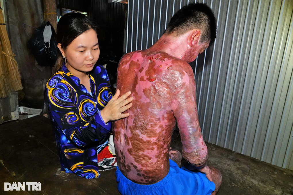 Người đàn ông bị bỏng hơn 90%, chỉ cầu mong sự sống để nuôi con - 5 Người đàn ông bị bỏng hơn 90%, chỉ cầu mong sự sống để nuôi con - 5