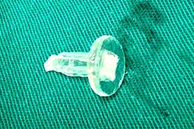 Cấp cứu nam sinh 11 tuổi khó thở nặng, nguy kịch vì thói quen ngậm bút bi