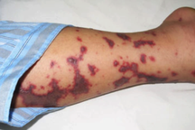 Đối phó với căn bệnh gây nhiễm trùng huyết, 135.000 ca tử vong/năm thế nào?