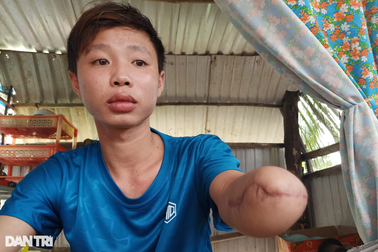 Bị tai nạn, chàng trai hiếu thảo mong có  tiền  lắp tay giả, phụ mẹ nuôi em