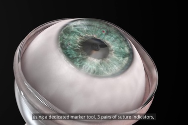 Hình ảnh thực tế của ca cấy ghép giác mạc tại Trung tâm Y học Rabin