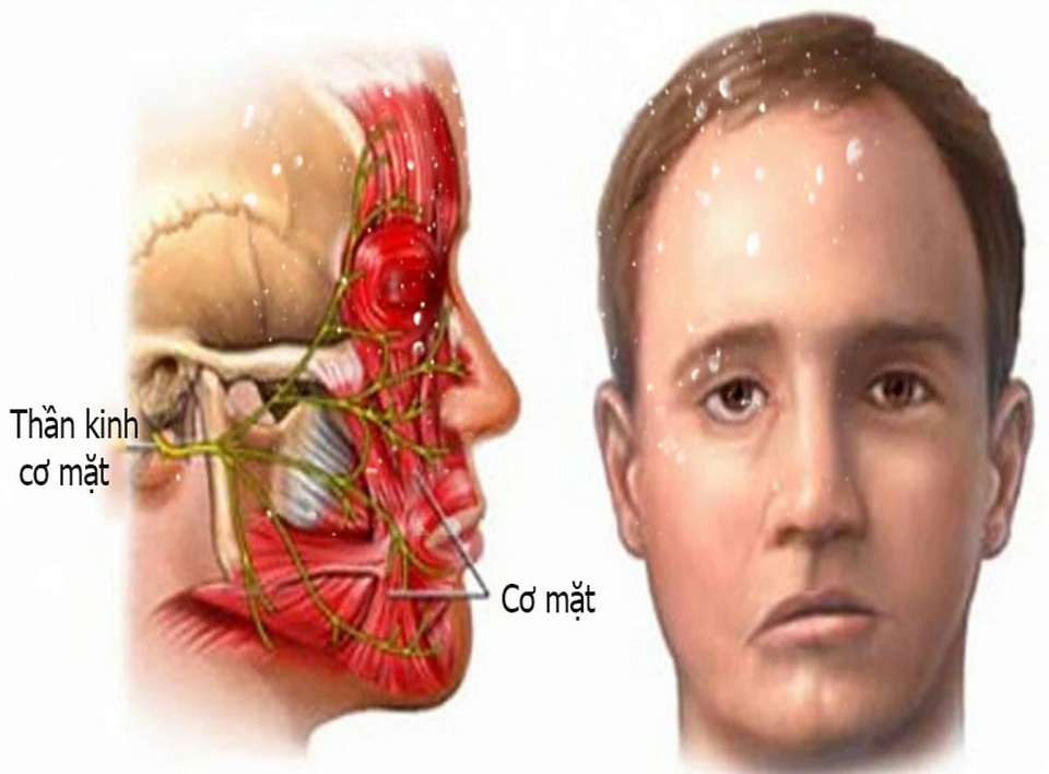Trẻ bị méo miệng sau một đêm nằm điều hòa lạnh - 1 Trẻ bị méo miệng sau một đêm nằm điều hòa lạnh - 1