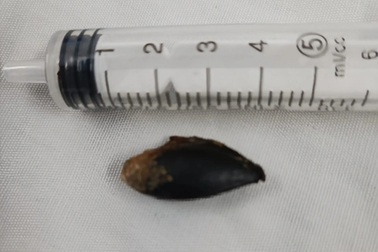 Hạt hồng xiêm nằm trong phế quản người đàn ông suốt 26 năm