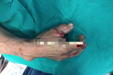 Nối lại thành công ngón tay cái đứt rời bằng kỹ thuật vi phẫu