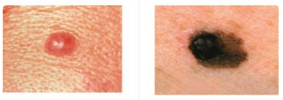 Dấu hiệu nhận biết nốt ruồi ung thư so với nốt ruồi thường - 2