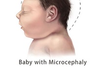 Những điều cần biết về tật đầu nhỏ