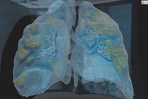 Video cho thấy phổi bị tổn thương nặng của bệnh nhân Covid-19