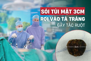 Sỏi mật 3cm rơi từ túi mật vào tá tràng gây tắc ruột