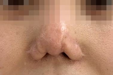 Chủ spa bị "băm nát" mũi sau 9 lần nâng cấp sửa chữa