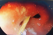 Quảng Bình: Bị đâm thủng dạ dày vì vô tình nuốt tăm tre vào bụng