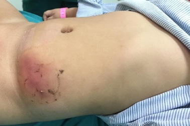 Bệnh nhi 2 tuổi hoại tử da vùng bụng vì dán cao trị mụn