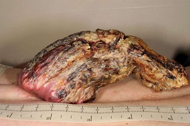 Người đàn ông Anh mọc “sừng rồng” trên lưng