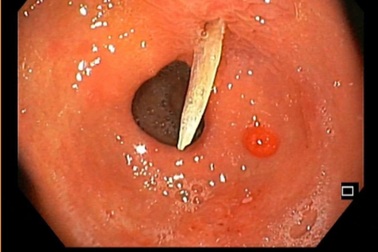 Bệnh nhân 79 tuổi bị xương cá 4cm đâm thủng dạ dày