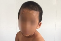 Nghi án bé trai bị cha dượng dùng dao cắt thịt, dí thuốc lá cháy vào mặt