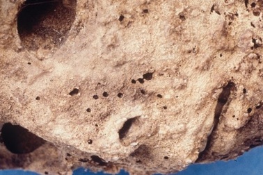 Xác ướp 400 năm tuổi làm thay đổi hiểu biết về bệnh viêm gan B