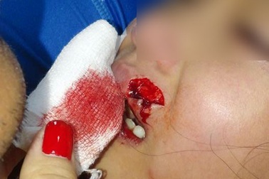 Bé gái 8 tuổi bị chó hàng xóm cắn rách môi